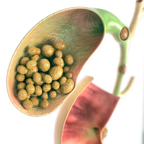 Gallstones are stones of hardened digestive