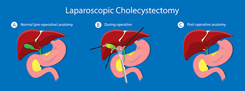 Cholecystectomy: A Laparoscopic Surgical Procedure Guide