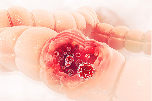 pictorial representation of colon cancer