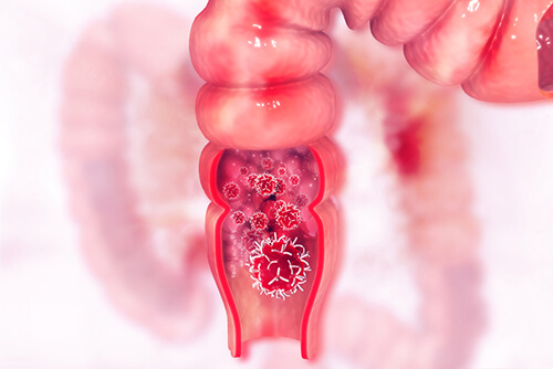 portraying colorectal surgery for anal fissure