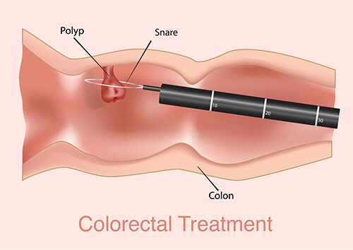 pictorial representation of colorectal surgery for colon cancer