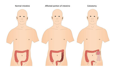 portraying colorectal treatment surgery procedure