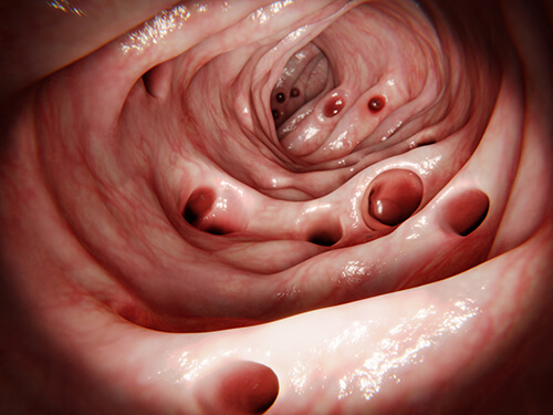 pictorial representation of diverticulitis a colorectal disease