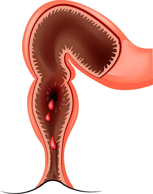 pictorial representation of colon cancer