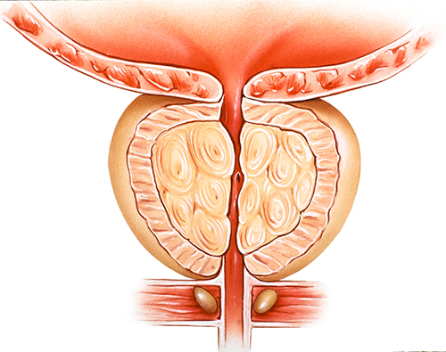 hyperplasia for hysterectomy