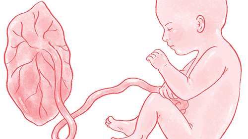 placenta accreta in hysterectomy