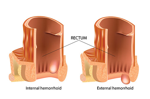 diagram showing internal and external hemorrhoids