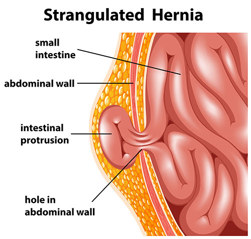 Strangulated organ