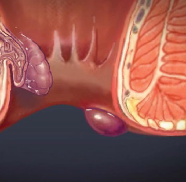 pictorial view of both internal and external hemorrhoids