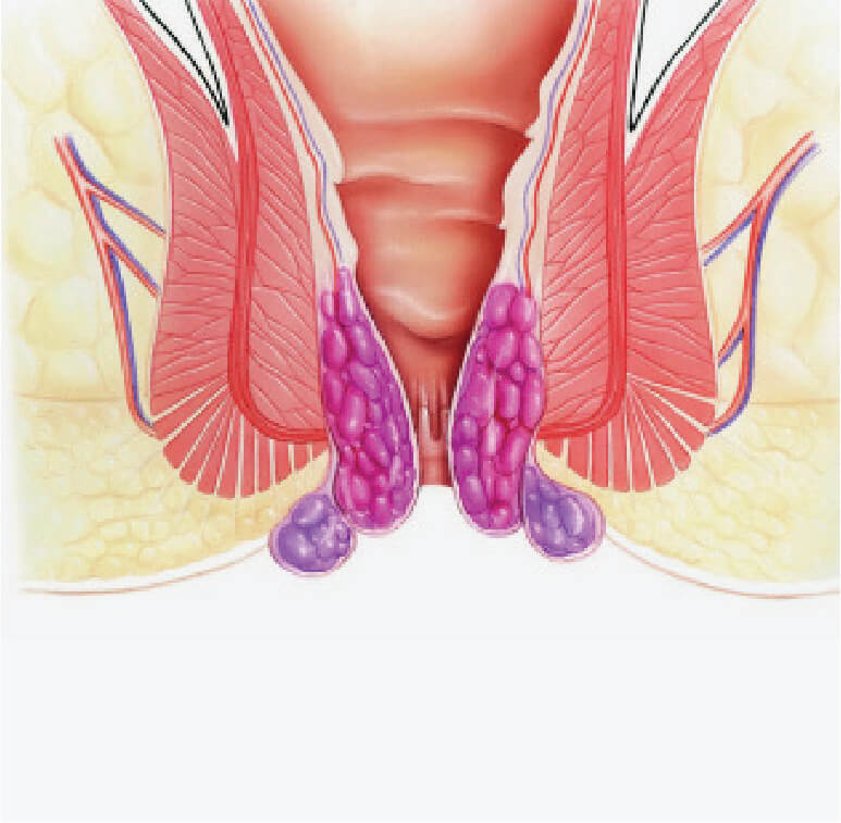 pictorial view of condition of hemorrhoids