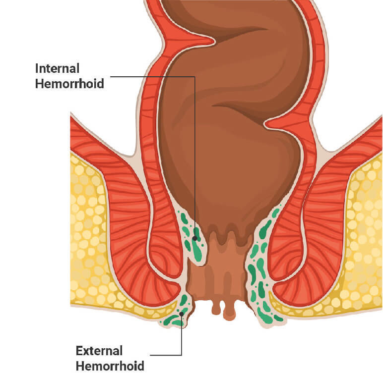 pictorial view of internal and external hemorrhoids 