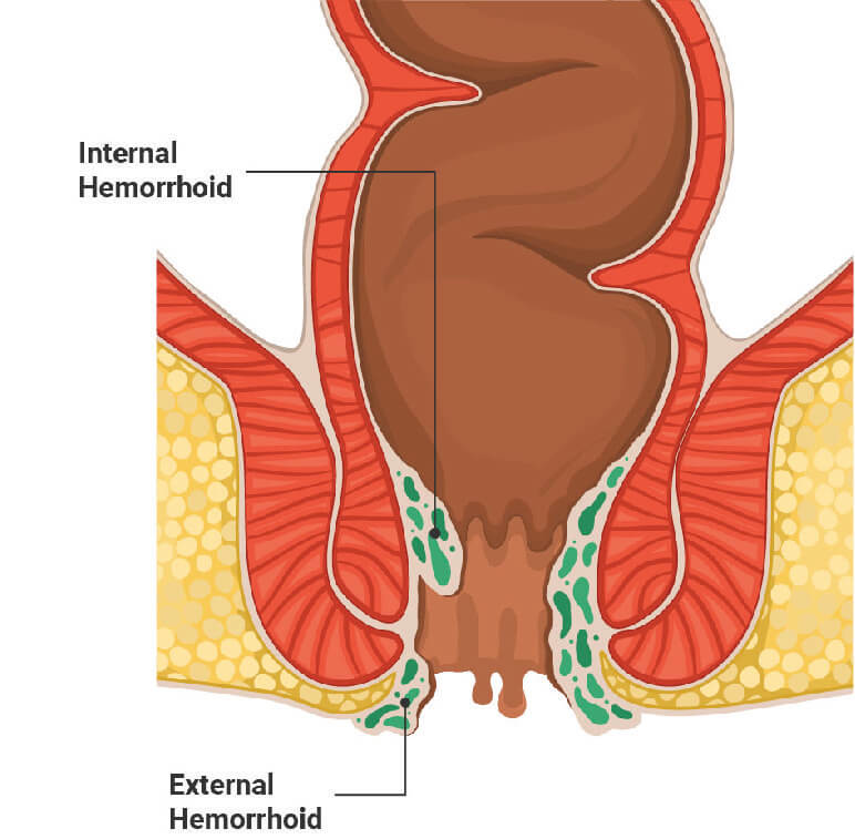 pictorial view of internal and external hemorrhoids