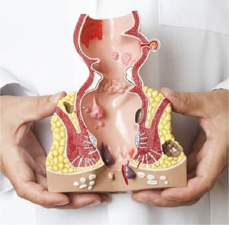 pictorial view of plastic model of hemorrhoids