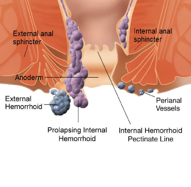 pictorial view of prolapsing hemorrhoid