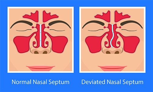 Deviated nasal septum- advanced surgical procedure is septoplasty