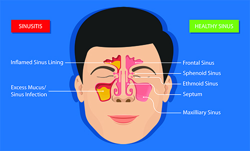 Sinus - chronic sinusitis - may occur if you have crooked septum