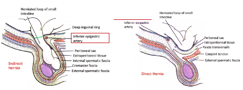 Direct-indirect hernia