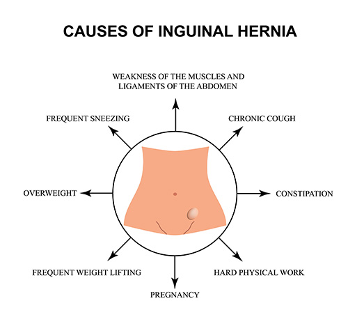 Causes of inguinal hernia