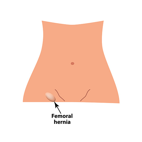 Femoral hernia