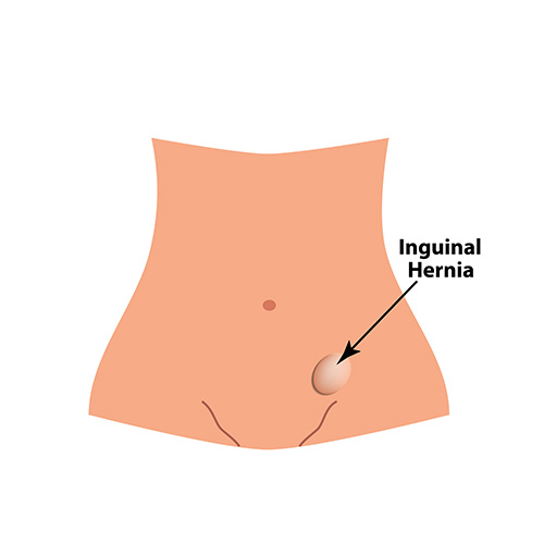 Inguinal hernia