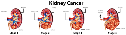 stages of kidney cancer