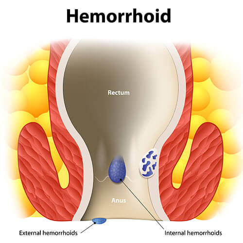 Internal and external hemorrhoids