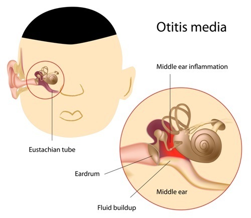 Middle ear infection treatment, ENT treatment, Advanced treatment