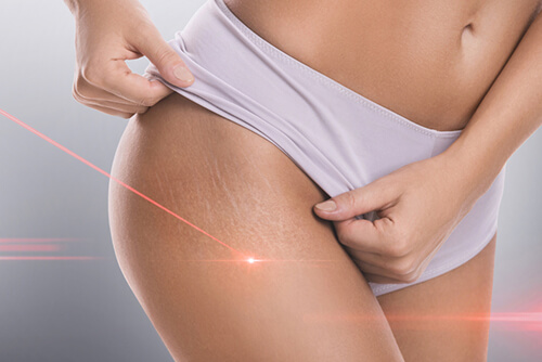 Laser Vaginal Rejuvenation