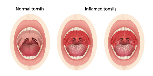 an image showing normal and infected tonsils