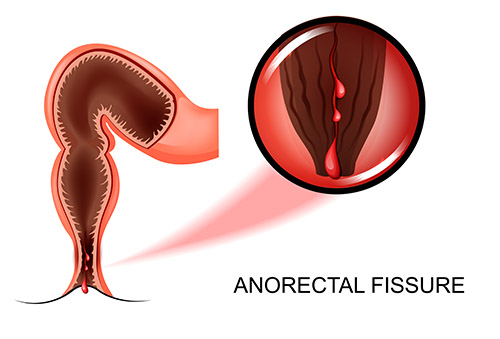 Anal fissure