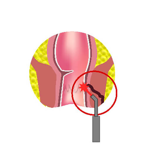 pictorial representation of how we can cure anal fistula permanently with laser