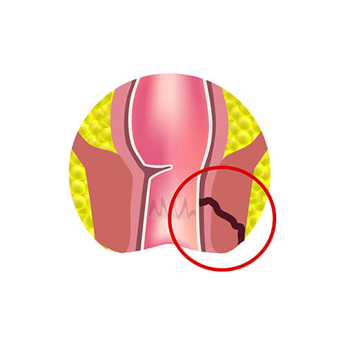portraying what anal fistula is