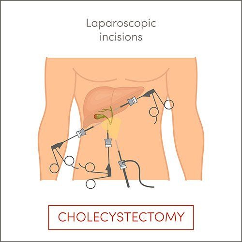 benefits of laparoscopic surgery