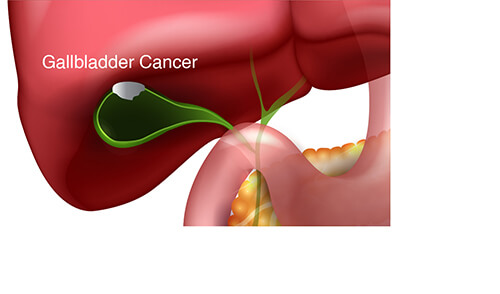 gall bladder cancer