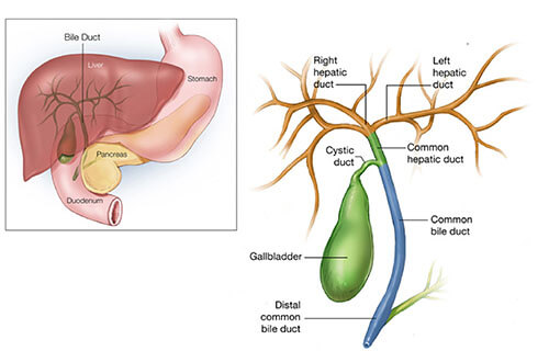 Bile duct injury in surgery