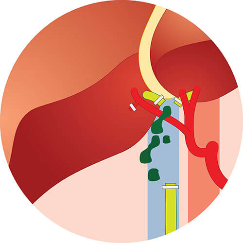 Bile leakage after gallbladder removal