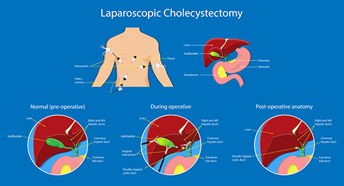 laparoscopic gallstone cholecystectomy
