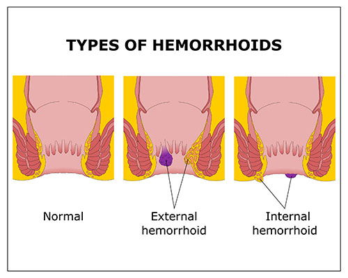 Hemorrhoids