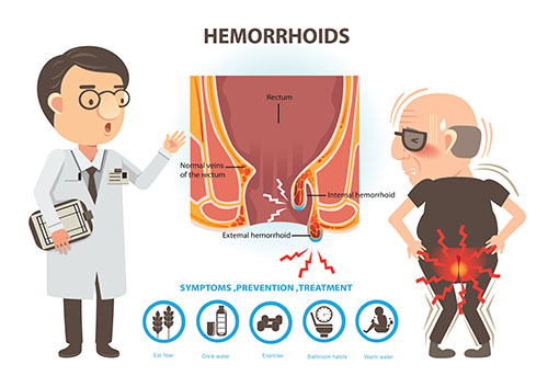Get diagnosed for piles