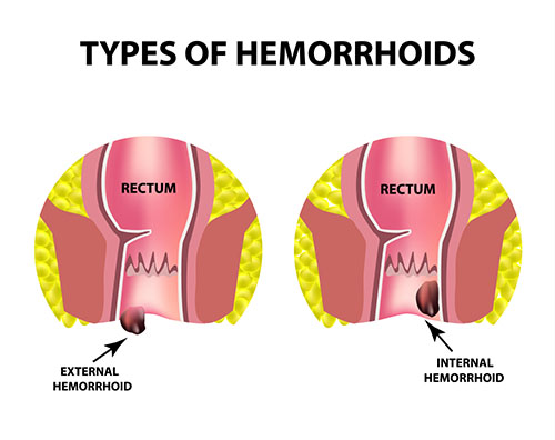 Types of hemorrhhoids