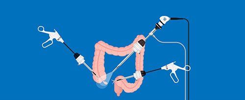 pictorial representation of the actual image of laparoscopy surgery