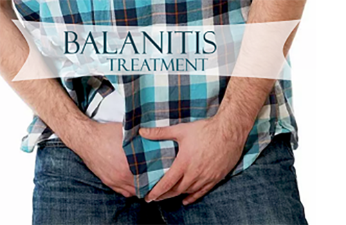 treatment for balanitis