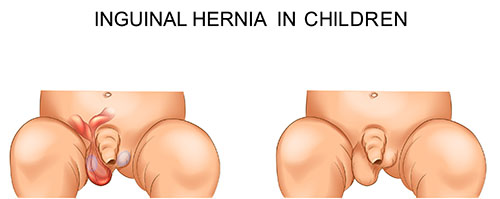 Inguinal hernia in a Baby
