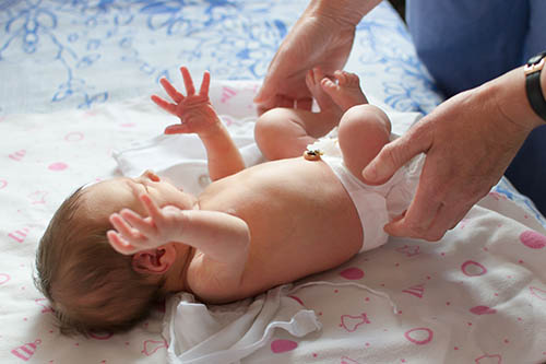 Umbilical Hernia In a Baby