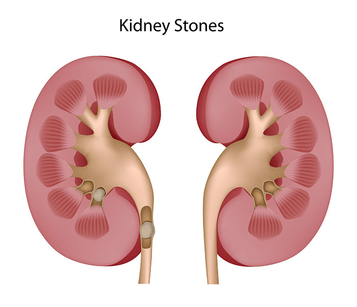 kidney stones presence