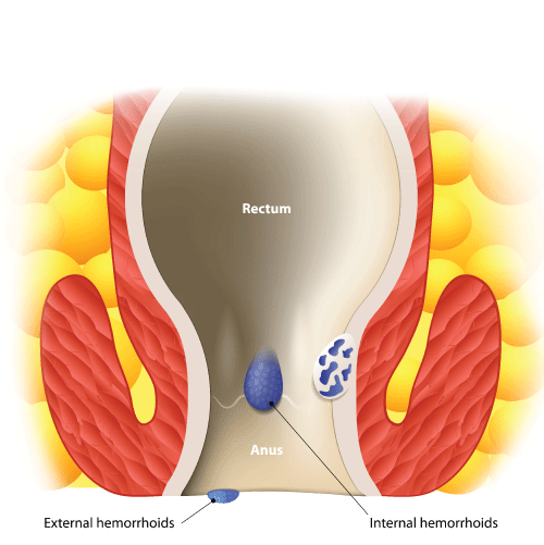 know what is Hemorrhoids