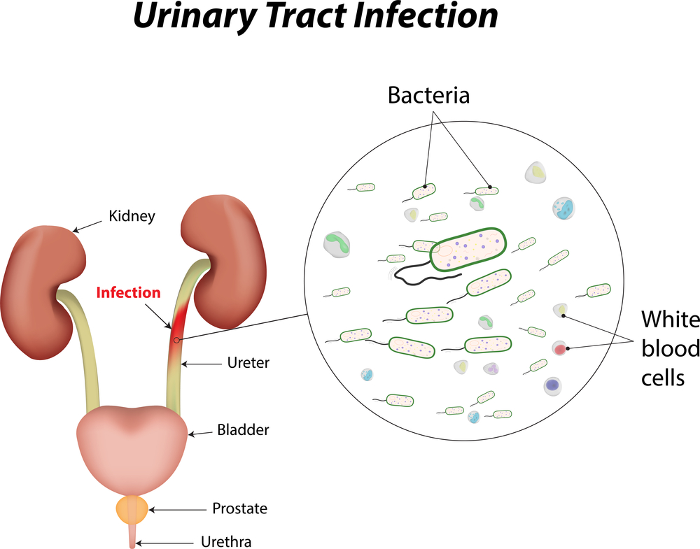 what is the meaning of urinary tract infection