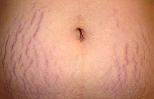 Image showing stretch marks