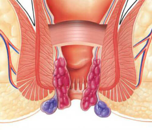 tissue responsible for the bleeding