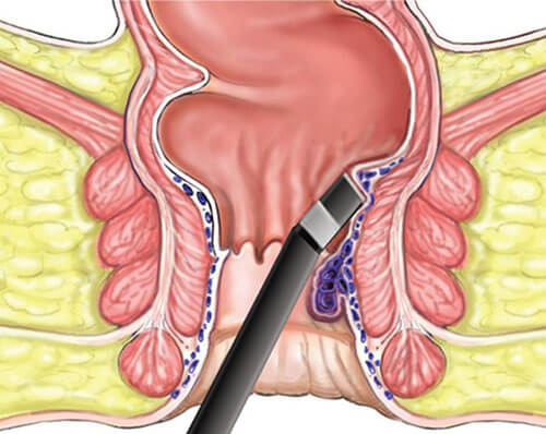hemorrhoid tissue will be burned